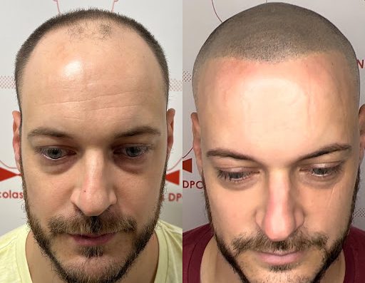 Bienvenue dans mon cabinet à Nantes dédié à la Dermopigmentation capillaire